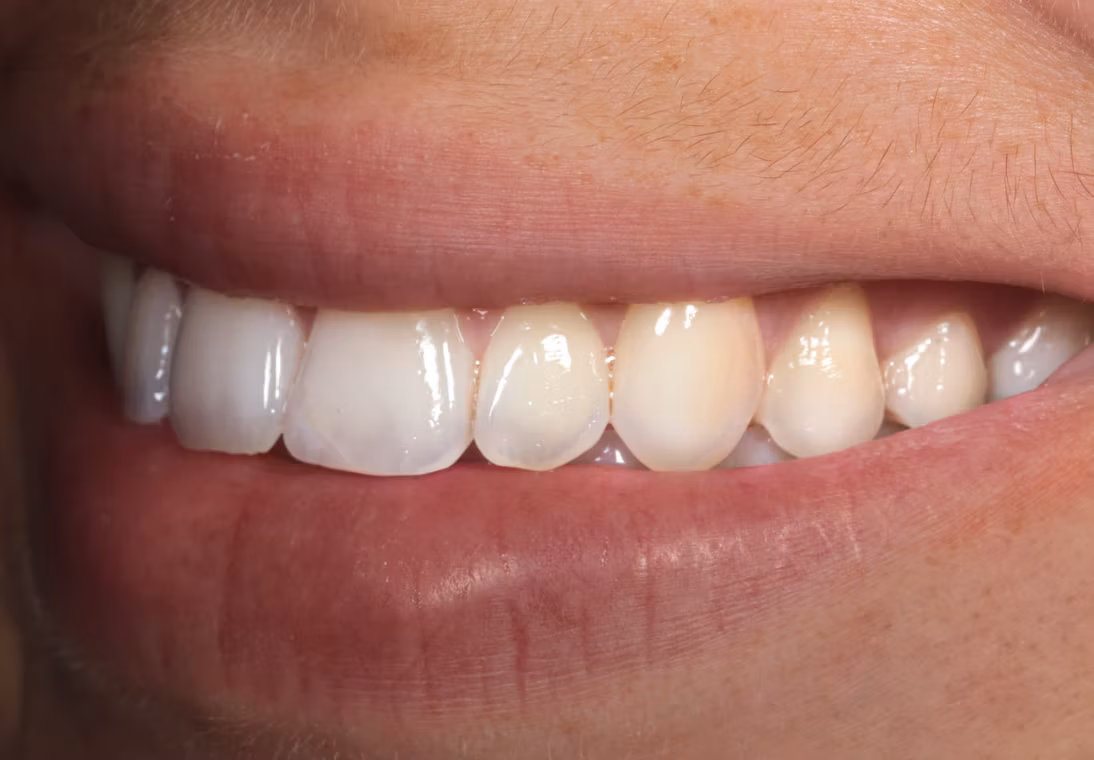 Photo of Smile After