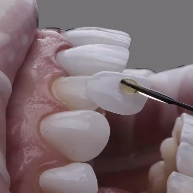 Veneers